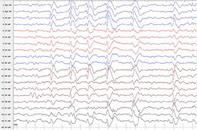 Identification of an Identical de Novo SCAMP5 Missense Variant in Four Unrelated Patients With Seizures and Severe Neurodevelopmental Delay